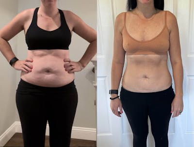 Weight Loss Before & After Gallery - Patient 188894 - Image 1