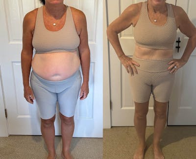 Weight Loss Before & After Gallery - Patient 491035 - Image 1