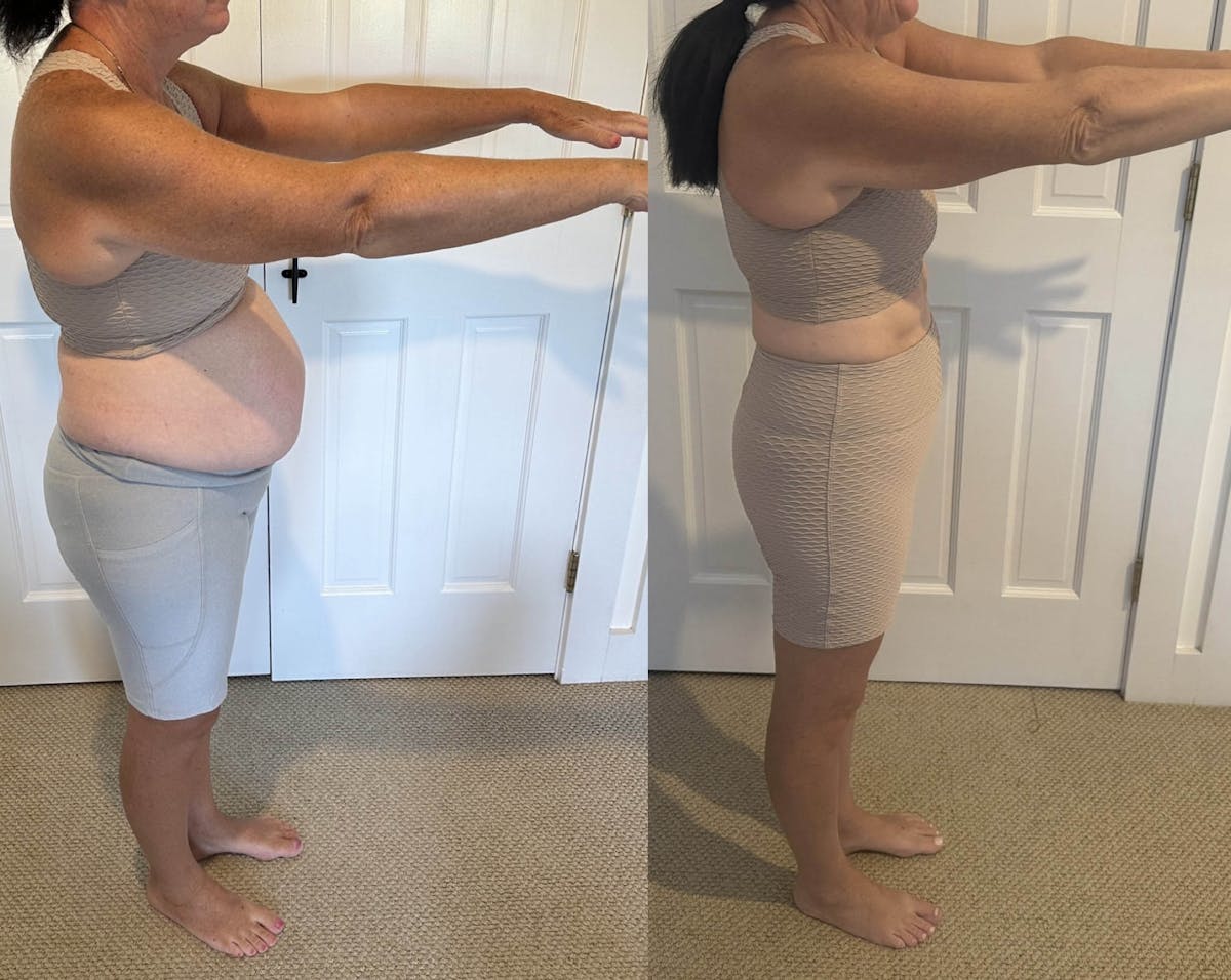 Weight Loss Before & After Gallery - Patient 491035 - Image 2