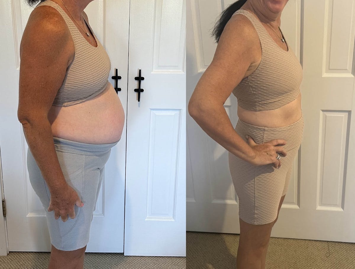 Weight Loss Before & After Gallery - Patient 491035 - Image 3