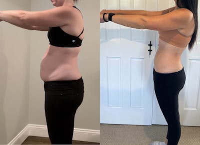 Weight Loss Before & After Gallery - Patient 474933 - Image 1