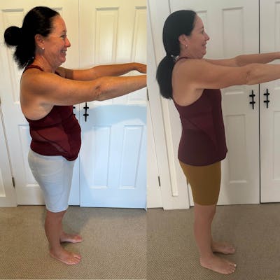 Weight Loss Before & After Gallery - Patient 827376 - Image 1
