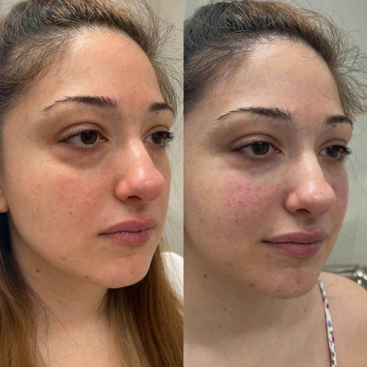 Tear Trough Filler Before & After Gallery - Patient 102997 - Image 1