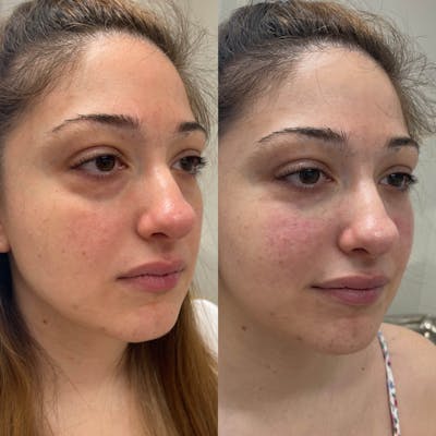 Tear Trough Filler Before & After Gallery - Patient 102997 - Image 1