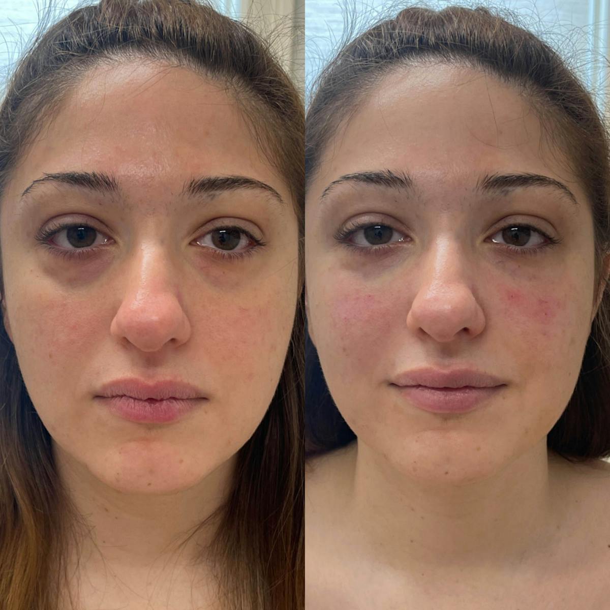 Tear Trough Filler Before & After Gallery - Patient 102997 - Image 2