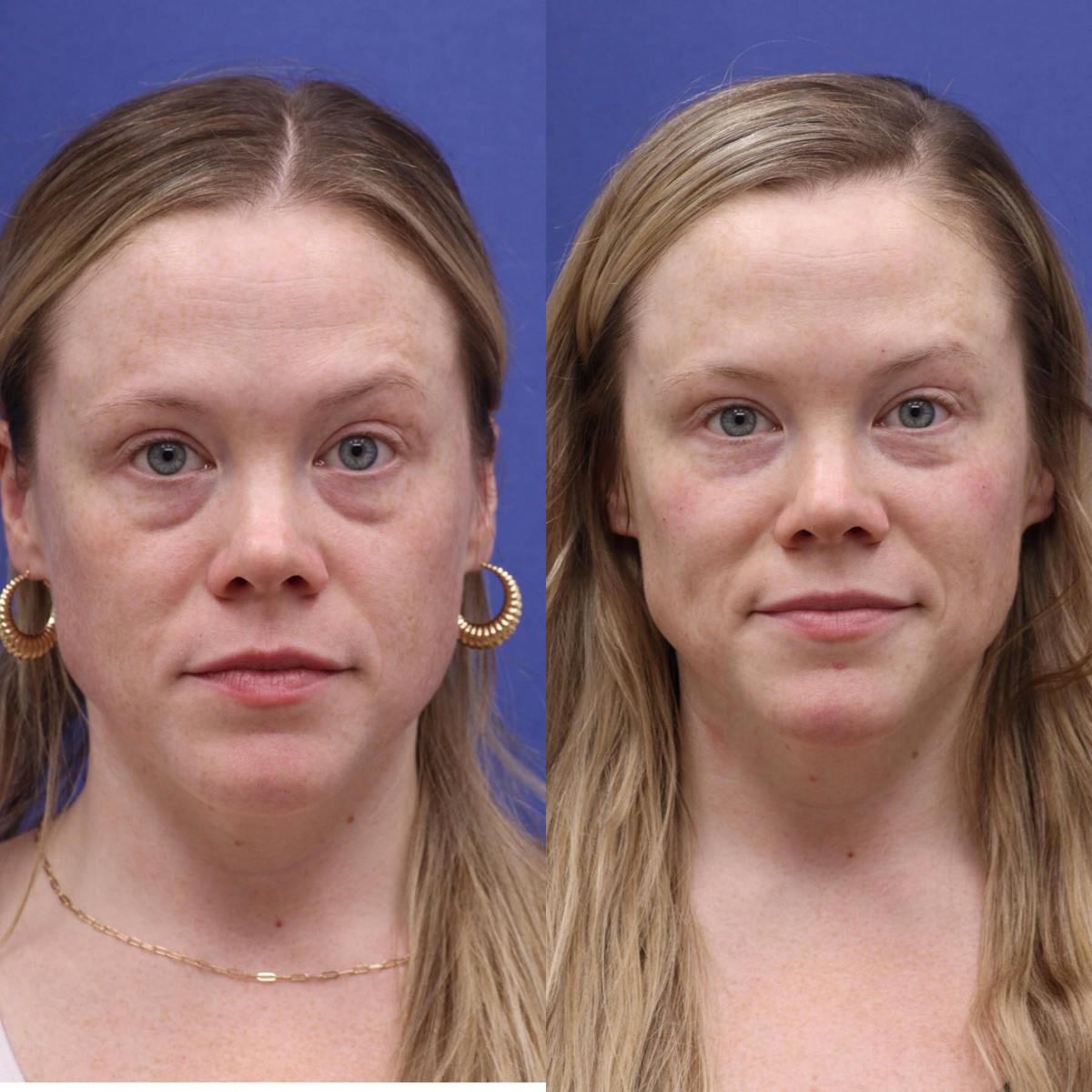 Tear Trough Filler Before & After Gallery - Patient 414460 - Image 1
