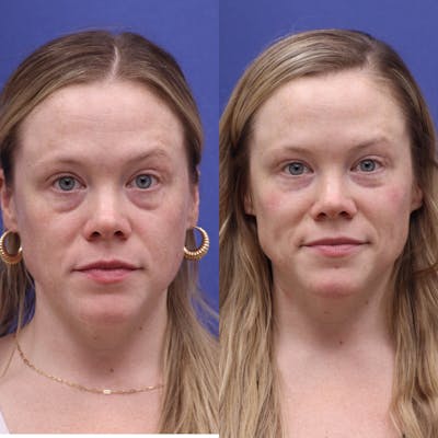 Tear Trough Filler Before & After Gallery - Patient 414460 - Image 1