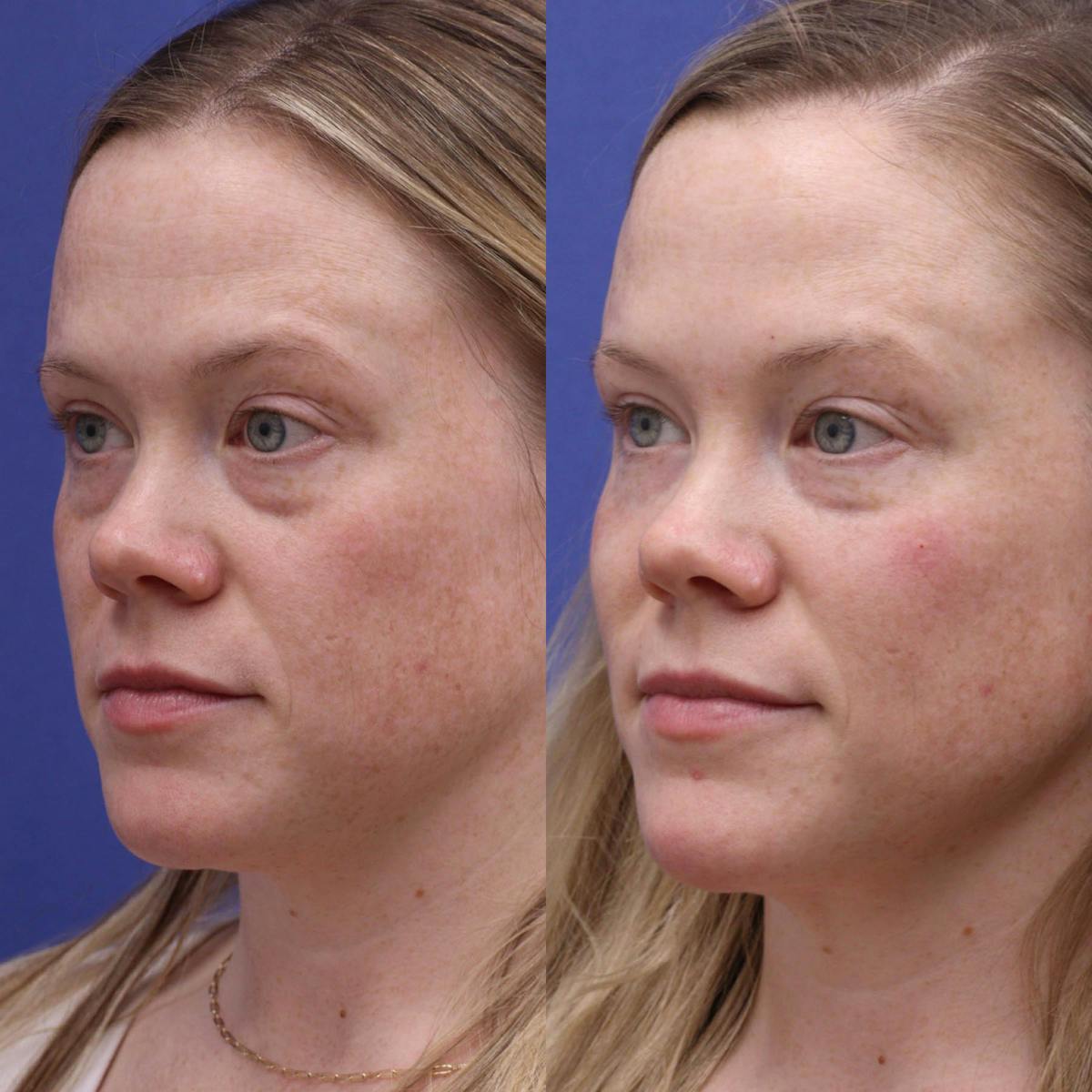 Tear Trough Filler Before & After Gallery - Patient 414460 - Image 3