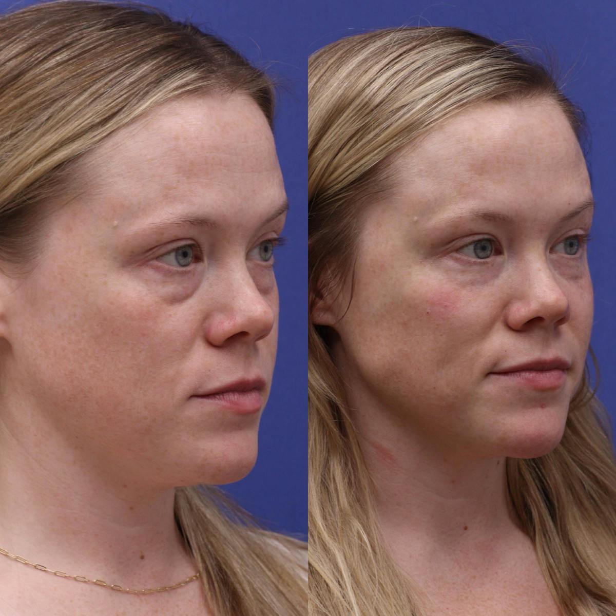 Tear Trough Filler Before & After Gallery - Patient 414460 - Image 2