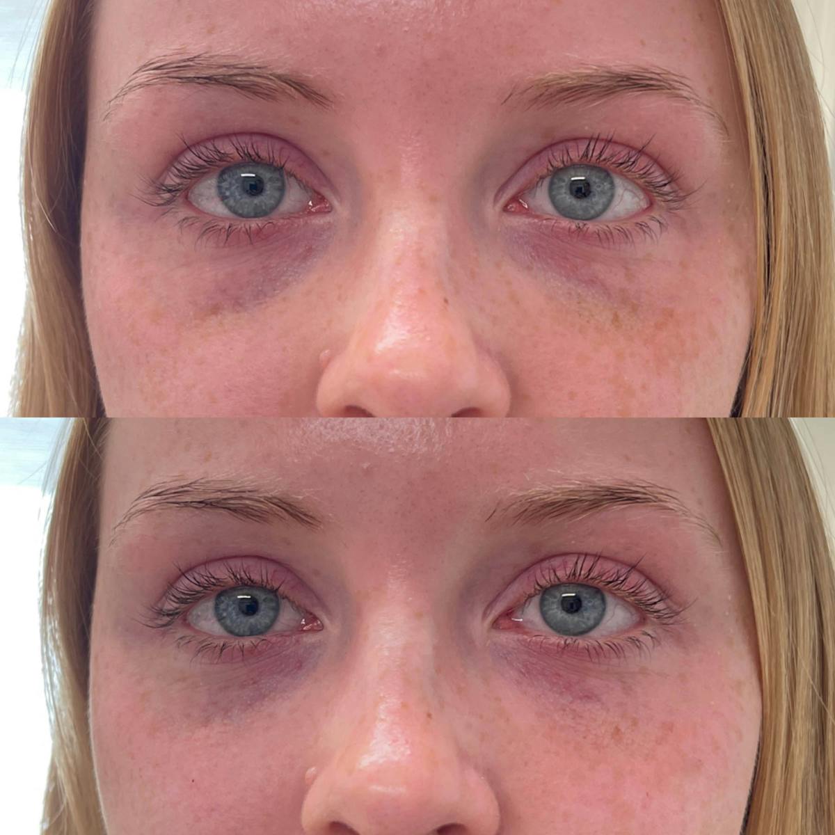 Tear Trough Filler Before & After Gallery - Patient 150258 - Image 1