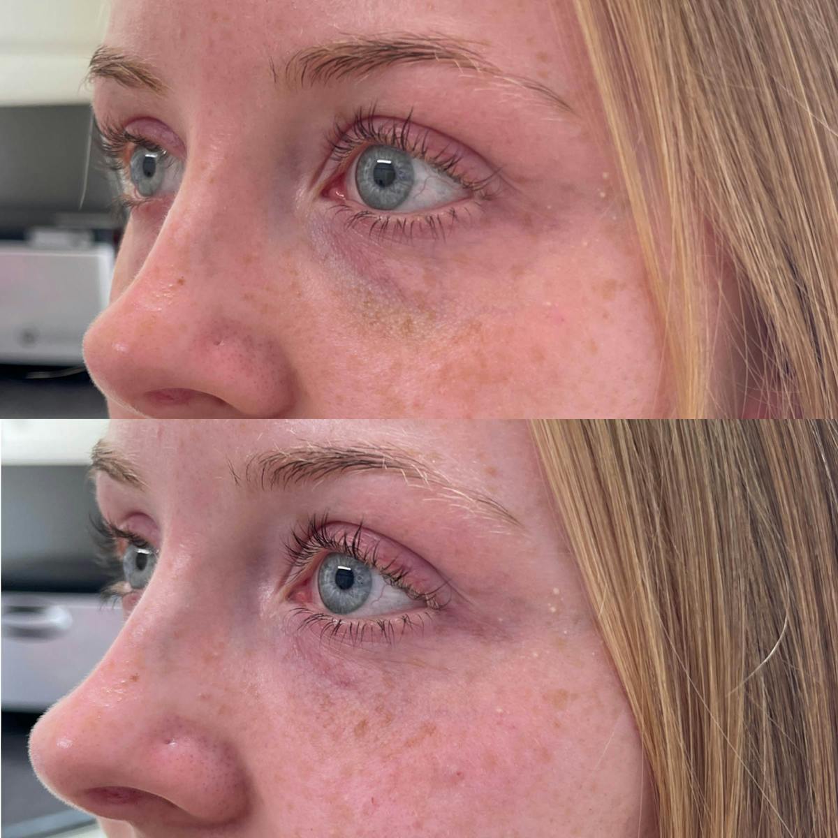 Tear Trough Filler Before & After Gallery - Patient 150258 - Image 2