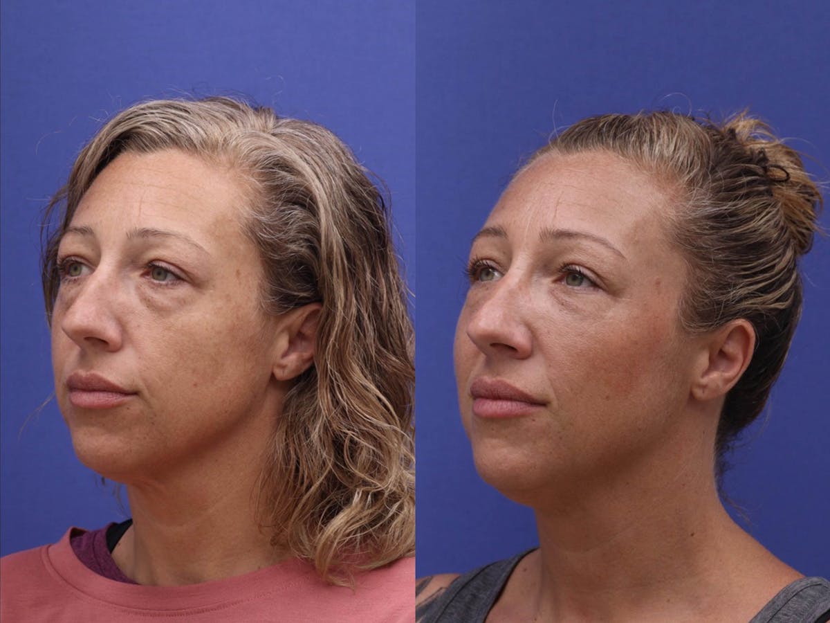 Tear Trough Filler Before & After Gallery - Patient 179806 - Image 2
