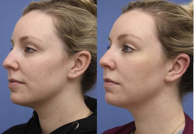 PDO Threads Before & After Gallery - Patient 349027 - Image 1