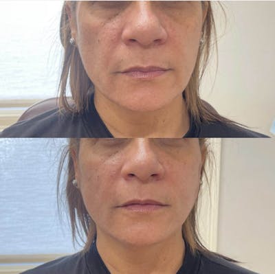 PDO Threads Before & After Gallery - Patient 358514 - Image 1