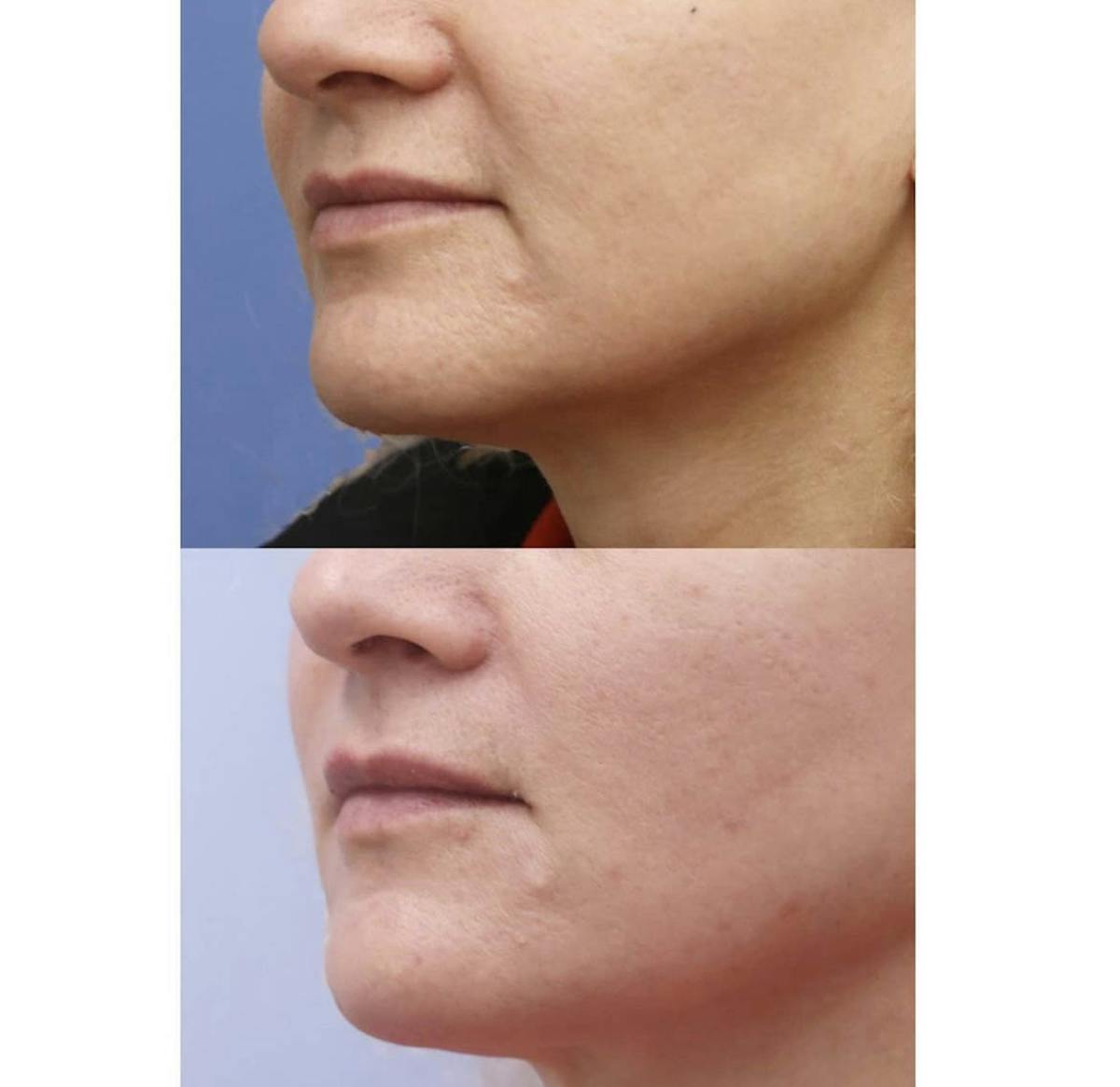 PDO Threads Before & After Gallery - Patient 123716 - Image 1
