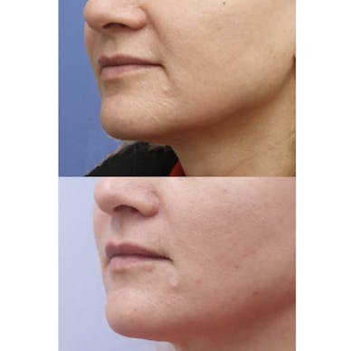 PDO Threads Before & After Gallery - Patient 123716 - Image 1