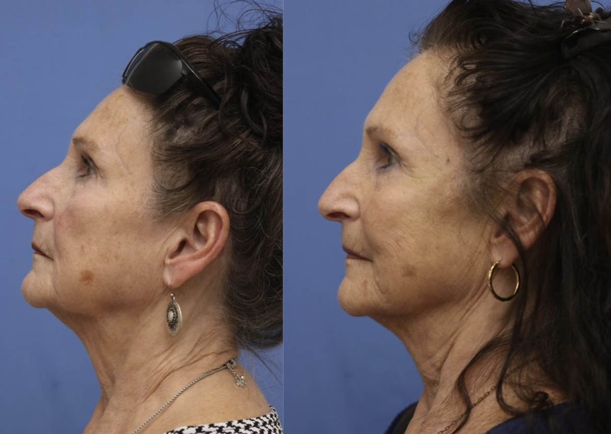 PDO Threads Before & After Gallery - Patient 305608 - Image 1