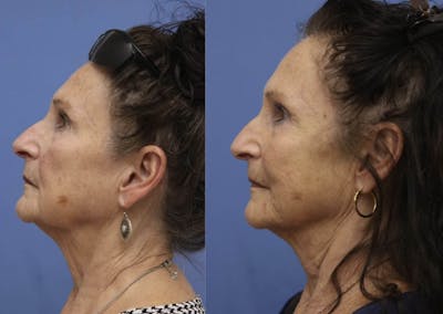 PDO Threads Before & After Gallery - Patient 305608 - Image 1