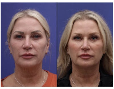 PDO Threads Before & After Gallery - Patient 101706 - Image 1