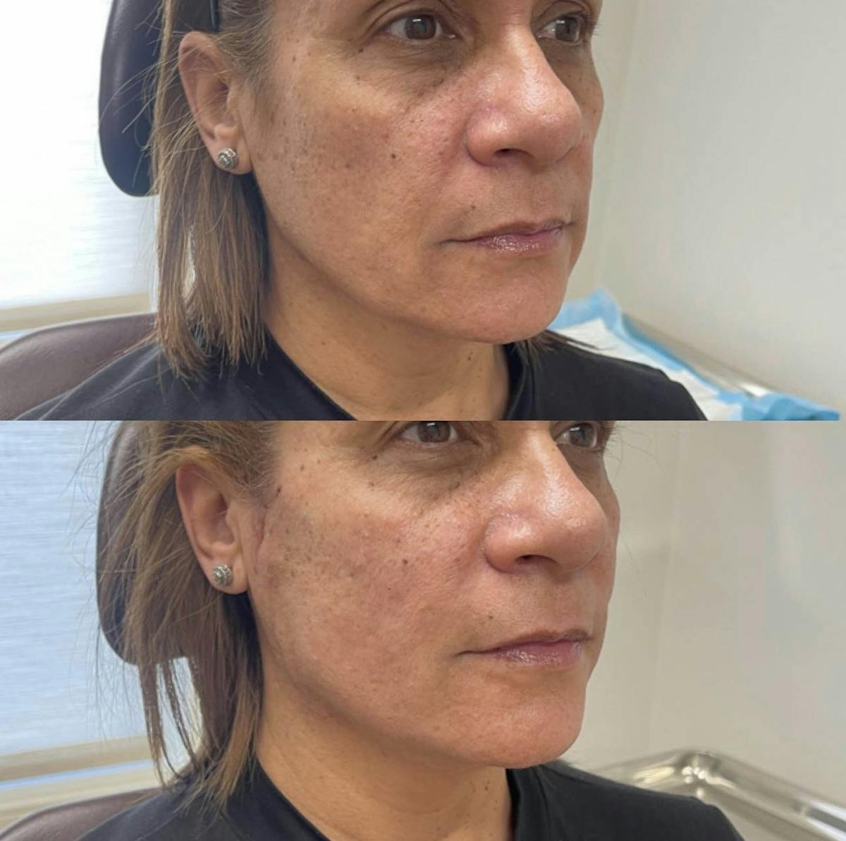 PDO Threads Before & After Gallery - Patient 358514 - Image 2