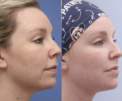 PDO Threads Before & After Gallery - Patient 210687 - Image 1