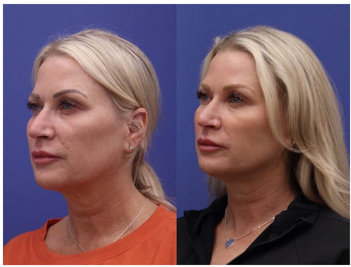 PDO Threads Before & After Gallery - Patient 101706 - Image 2