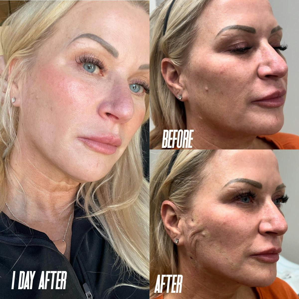 PDO Threads Before & After Gallery - Patient 203806 - Image 1
