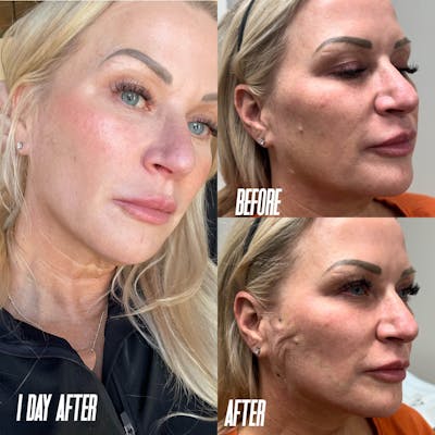 PDO Threads Before & After Gallery - Patient 203806 - Image 1