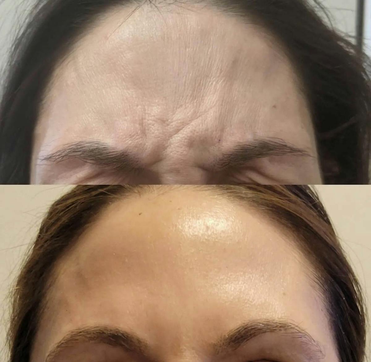 Neurotoxins Before & After Gallery - Patient 125510 - Image 1