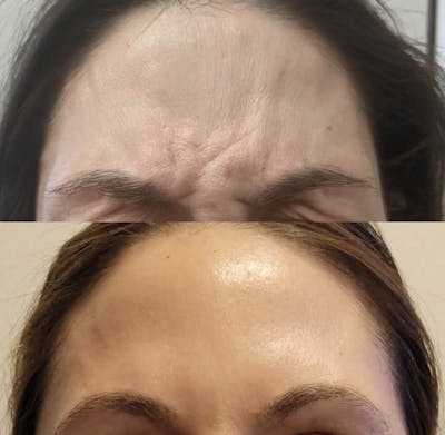 Neurotoxins Before & After Gallery - Patient 125510 - Image 1