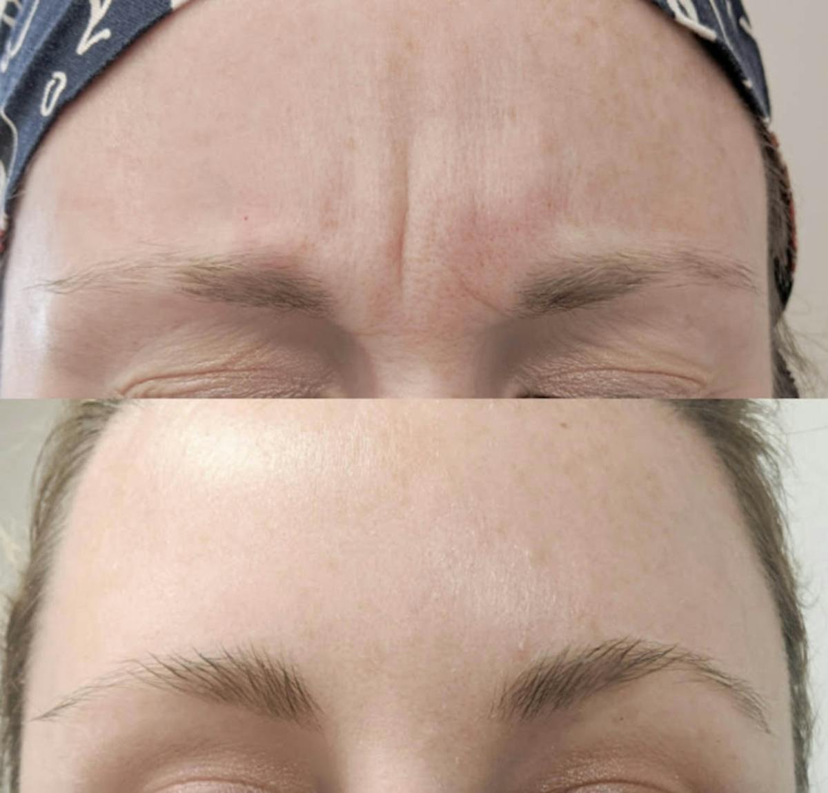 Neurotoxins Before & After Gallery - Patient 170698 - Image 1