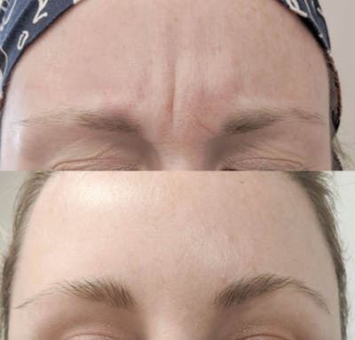 Neurotoxins Before & After Gallery - Patient 170698 - Image 1
