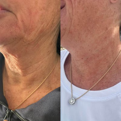 Neurotoxins Before & After Gallery - Patient 262648 - Image 1