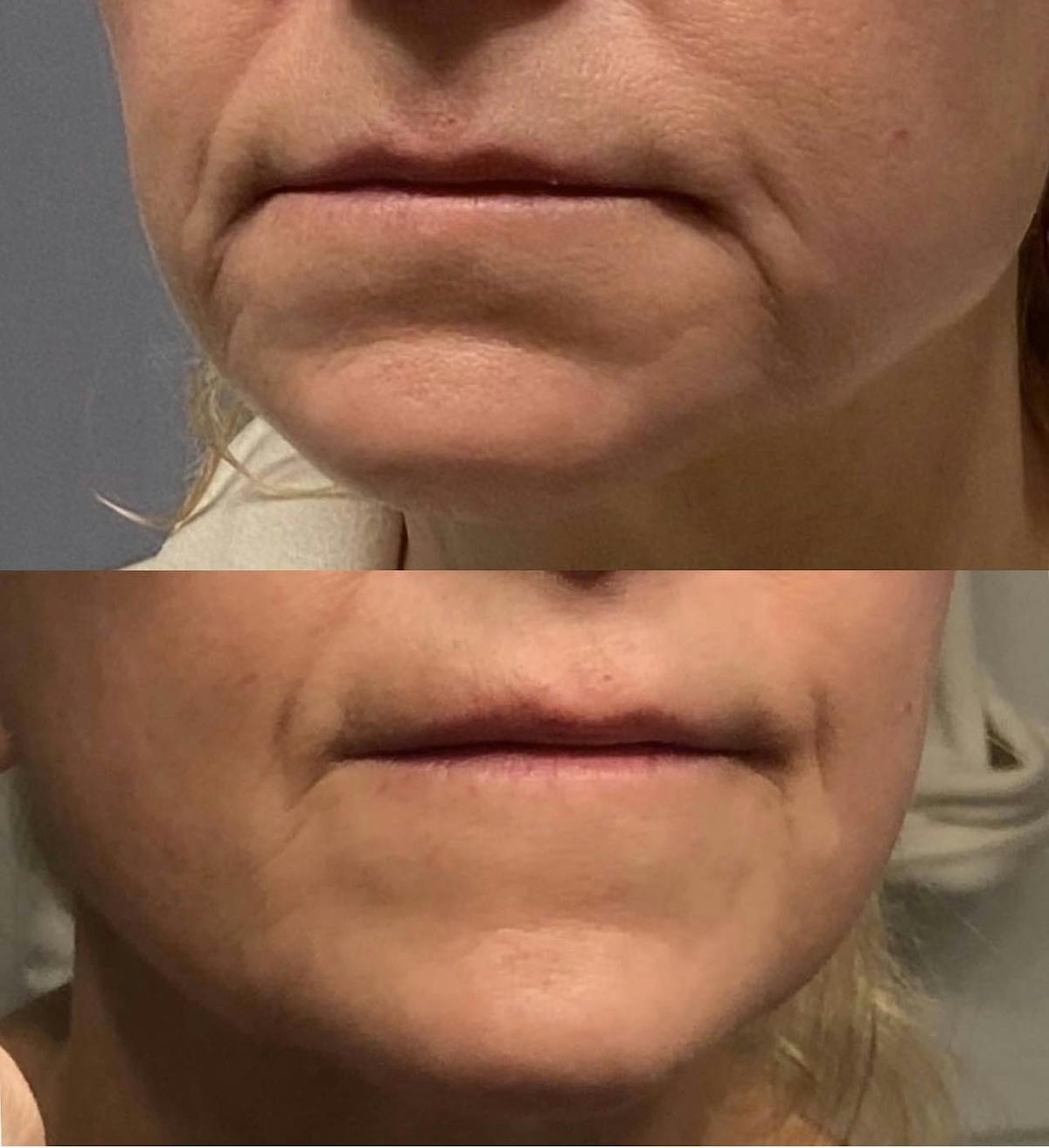 Neurotoxins Before & After Gallery - Patient 259186 - Image 1