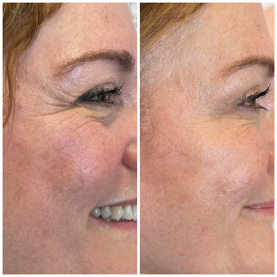 Neurotoxins Before & After Gallery - Patient 179384 - Image 1