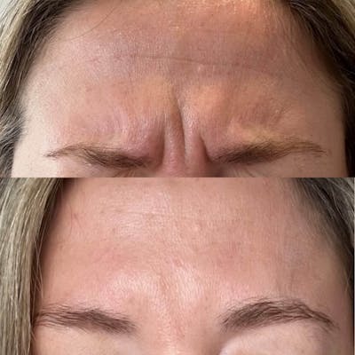 Neurotoxins Before & After Gallery - Patient 988308 - Image 1