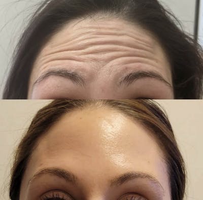 Neurotoxins Before & After Gallery - Patient 271129 - Image 1