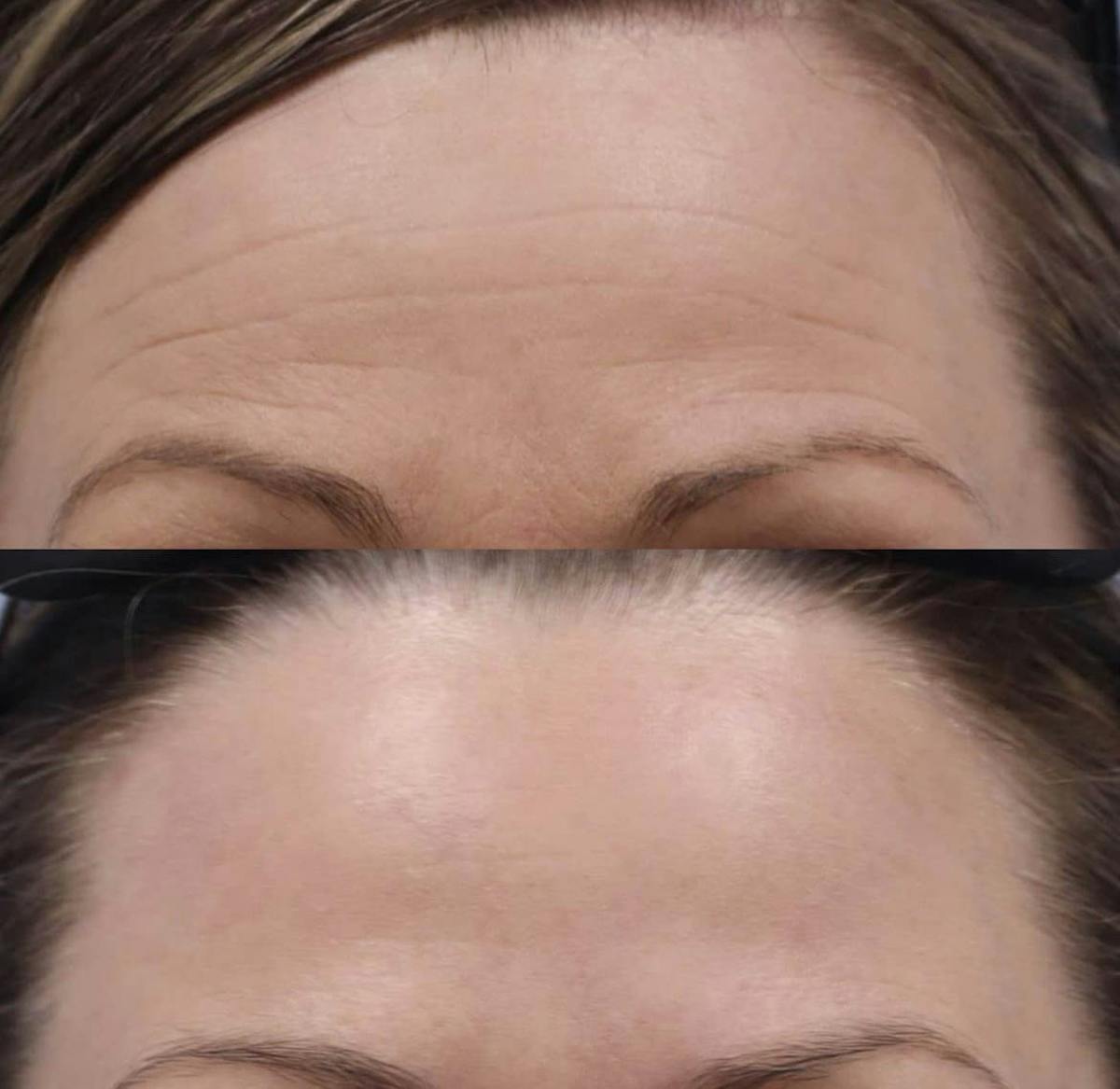 Neurotoxins Before & After Gallery - Patient 403004 - Image 1