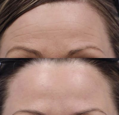 Neurotoxins Before & After Gallery - Patient 403004 - Image 1