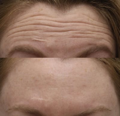 Neurotoxins Before & After Gallery - Patient 321164 - Image 1