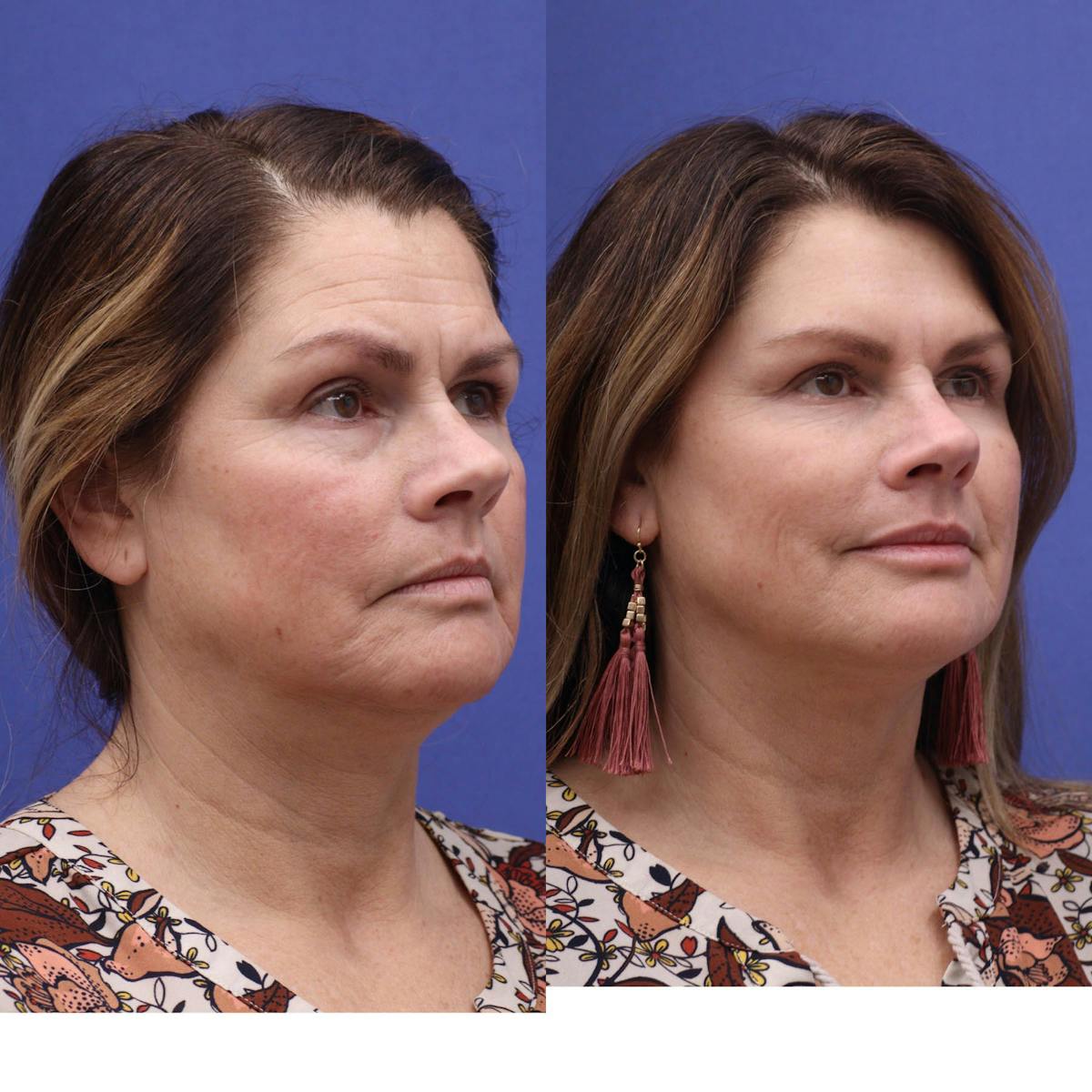 Neurotoxins Before & After Gallery - Patient 419280 - Image 1