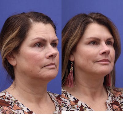 Neurotoxins Before & After Gallery - Patient 419280 - Image 1