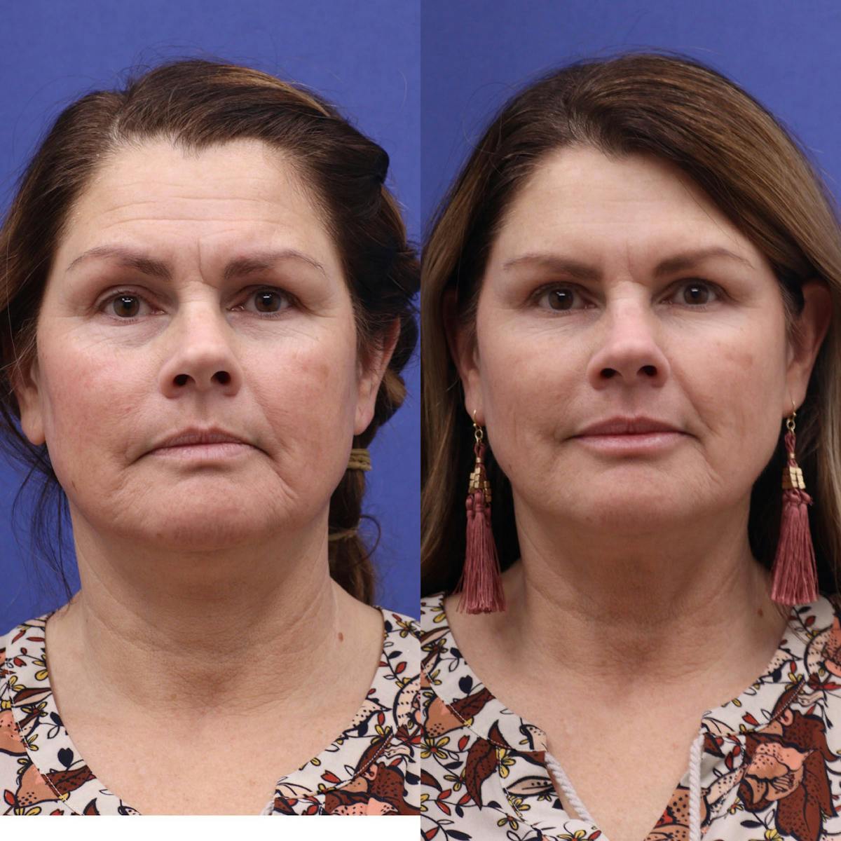 Neurotoxins Before & After Gallery - Patient 419280 - Image 2