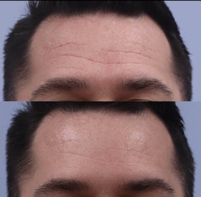 Neurotoxins Before & After Gallery - Patient 194627 - Image 1