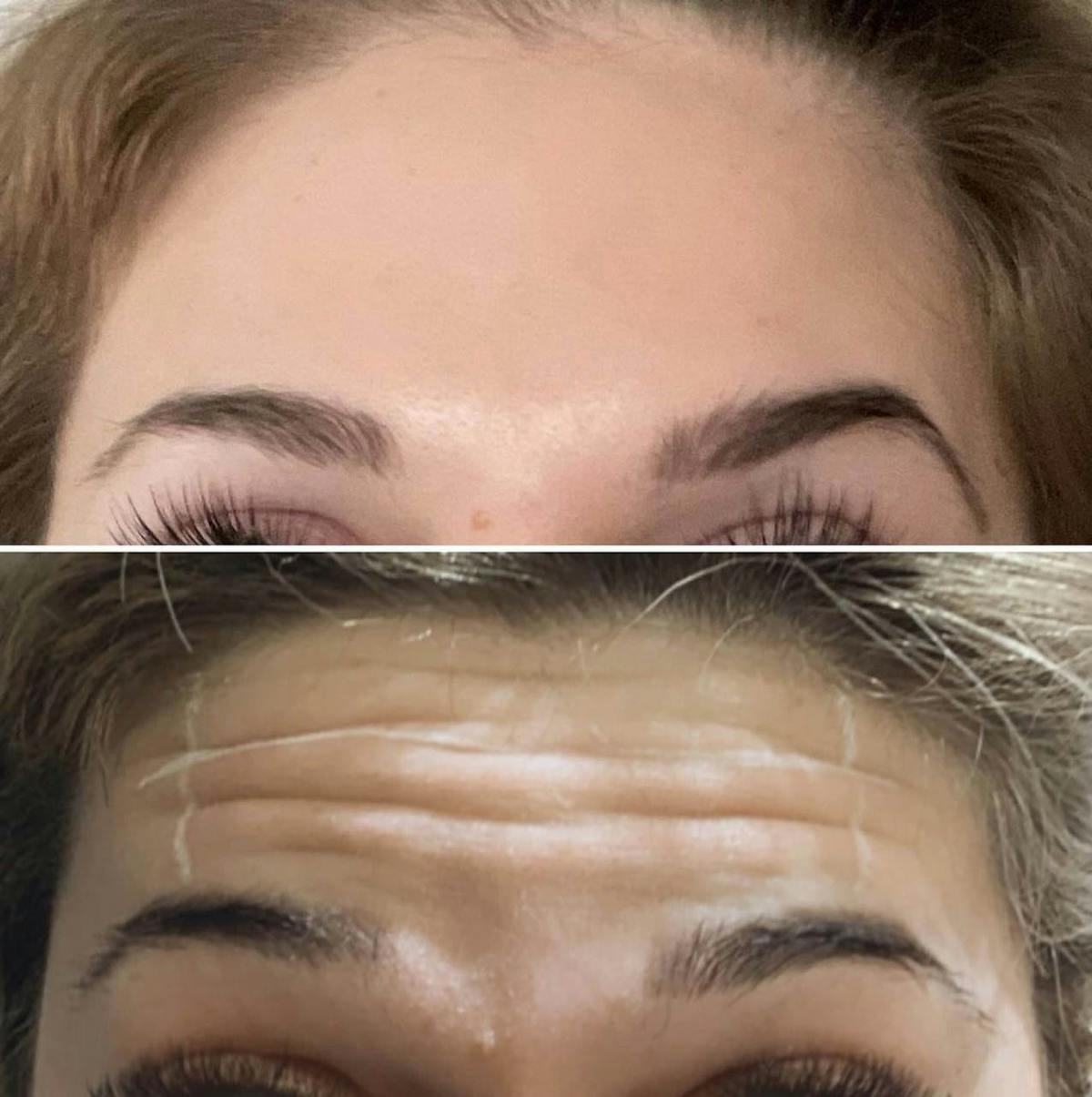 Neurotoxins Before & After Gallery - Patient 278512 - Image 1