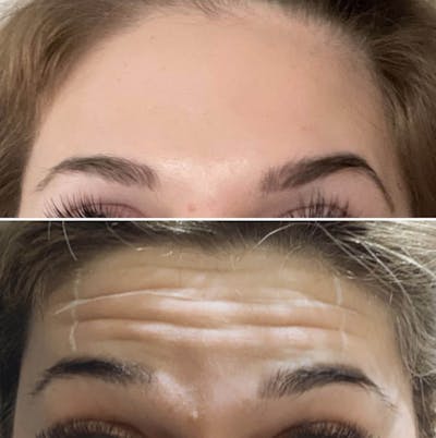 Neurotoxins Before & After Gallery - Patient 278512 - Image 1