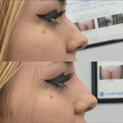 Liquid Rhinoplasty Before & After Gallery - Patient 234313 - Image 1