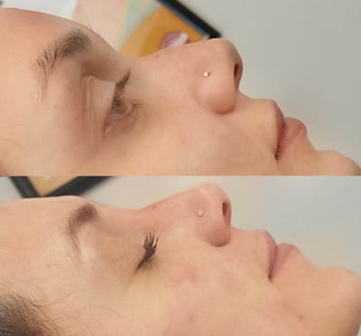 Liquid Rhinoplasty Before & After Gallery - Patient 640979 - Image 1