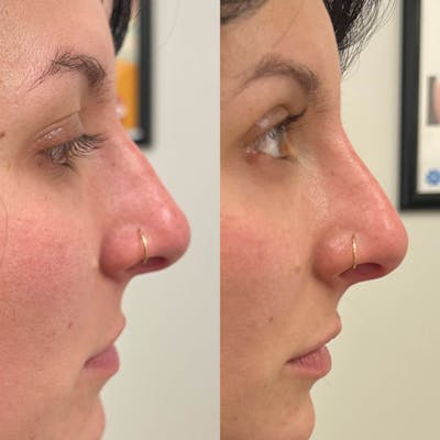 Liquid Rhinoplasty Before & After Gallery - Patient 165156 - Image 1