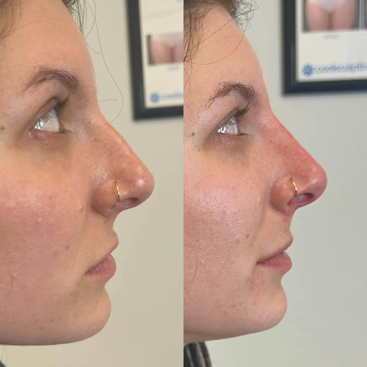 Liquid Rhinoplasty Before & After Gallery - Patient 165156 - Image 2